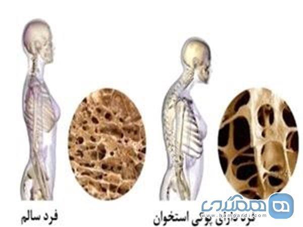 چگونه لاغر شدن ما را به پوکی استخوان مبتلا می کند؟ چگونه لاغر شدن ما را به پوکی استخوان مبتلا می نماید؟
